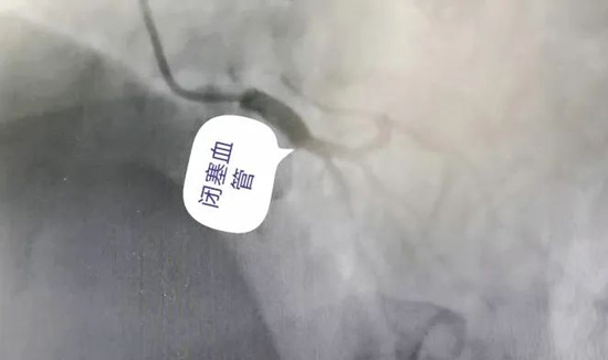 緊急！時間與死神的較量，年輕人更應該警惕這病……