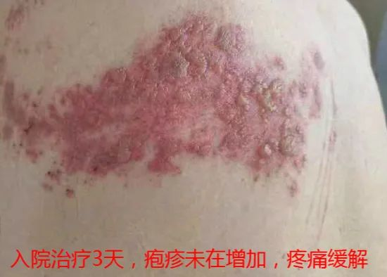 “蛇纏腰”痛起來像被100個容嬤嬤拿針扎？