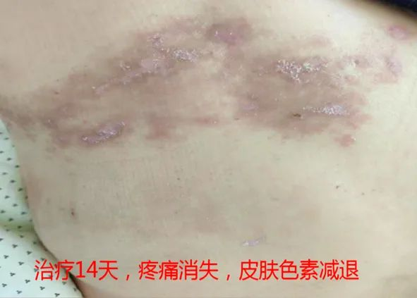 “蛇纏腰”痛起來像被100個容嬤嬤拿針扎？