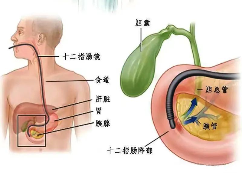 身體里隱藏著“瘋狂的石頭”，如何拯救？