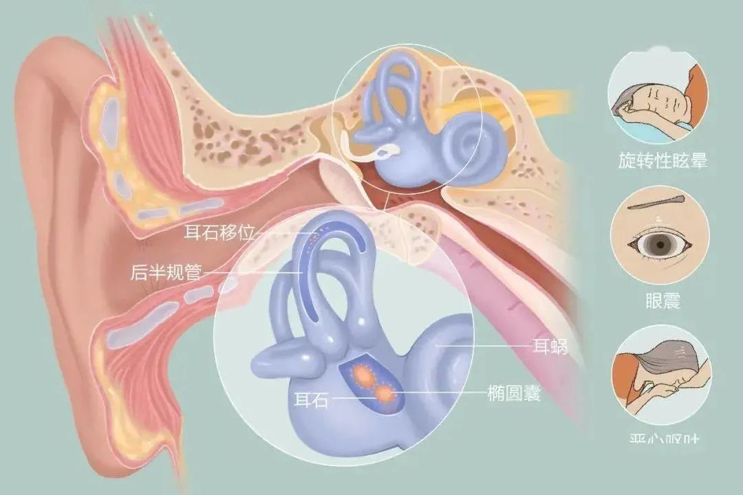 動不動就天旋地轉 ，這樣的感覺，你也有嗎？