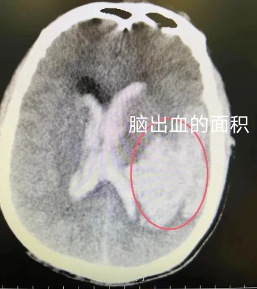 56歲的他，為何時隔10年再發腦出血？