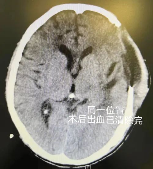 56歲的他，為何時隔10年再發腦出血？