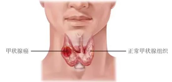 甲狀腺癌沖上“熱搜”！是良是惡？一針見分曉！