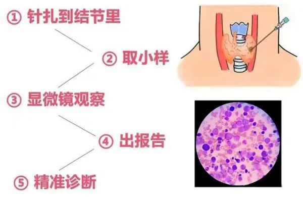 甲狀腺癌沖上“熱搜”！是良是惡？一針見分曉！