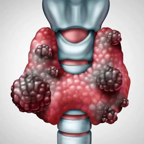 甲狀腺癌沖上“熱搜”！是良是惡？一針見分曉！