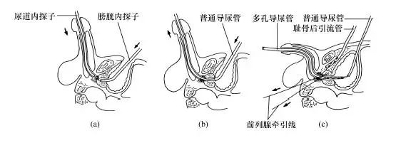 尿道會師術