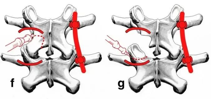 腰椎減壓融合術、經皮內固定術