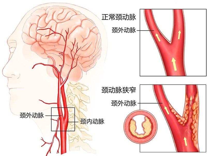 頸動脈說明