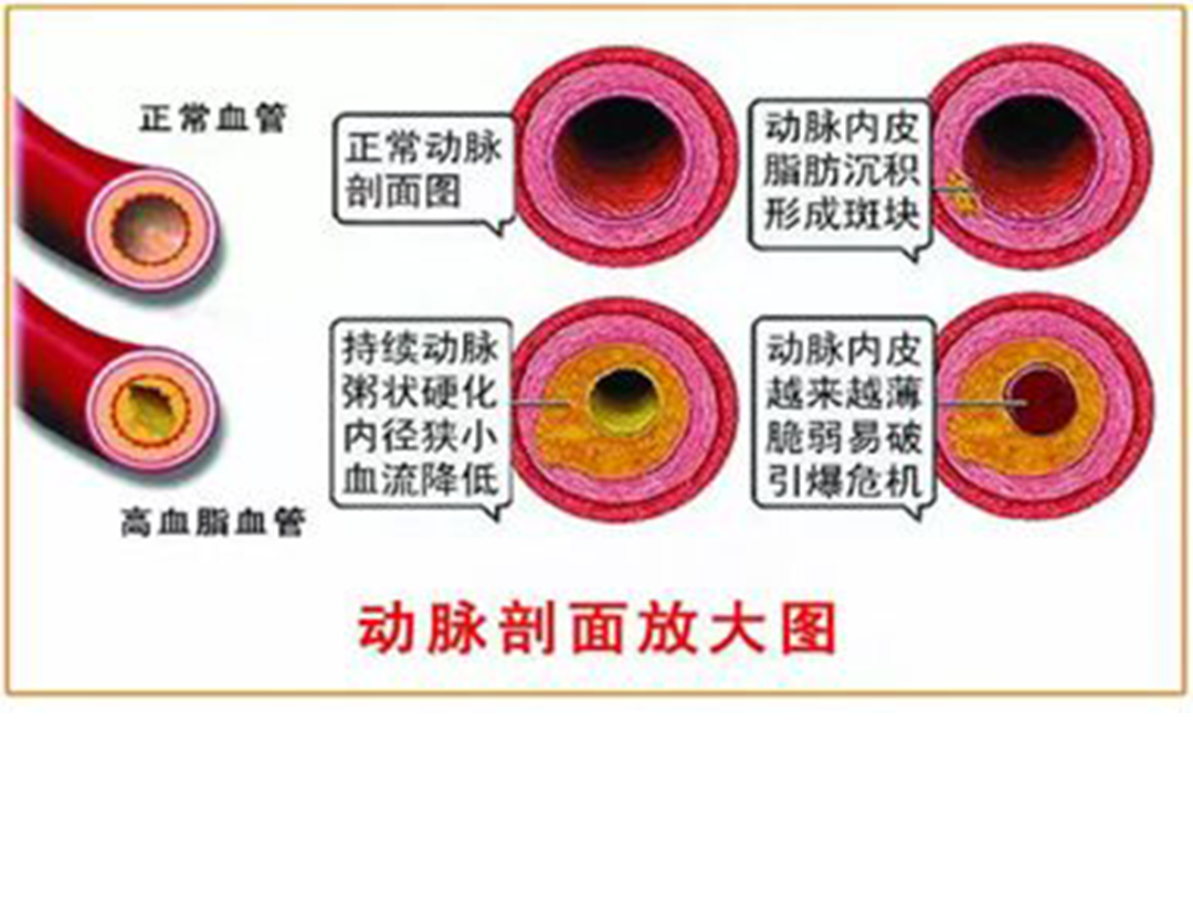 頸動脈刨面圖