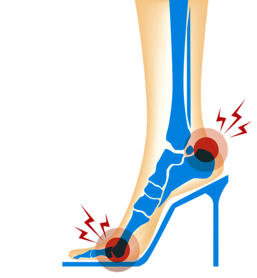 高跟鞋籽骨炎