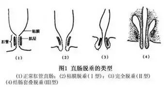 直腸粘膜內脫垂