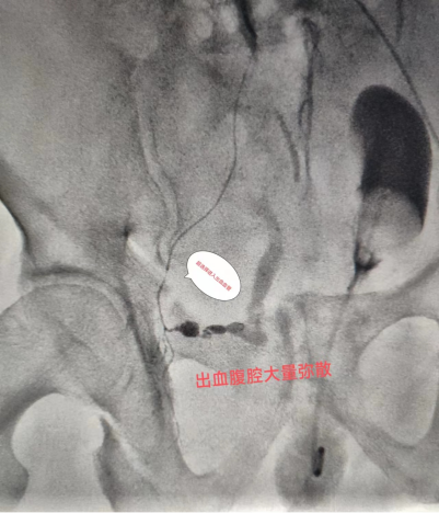 術中可見動脈破裂出血，超選入出血動脈造影證實