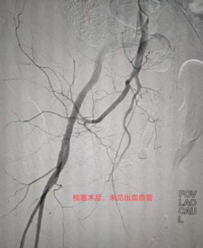 栓塞后造影復查，動脈出血消失