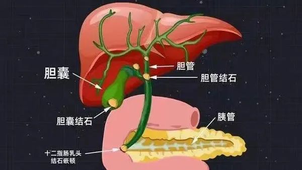 雙“鏡”合璧，一步到位，讓膽結石“無處可循”！