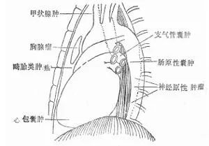 他因外傷入院，竟意外發現胸腔內隱藏著一個雞蛋大的腫物......