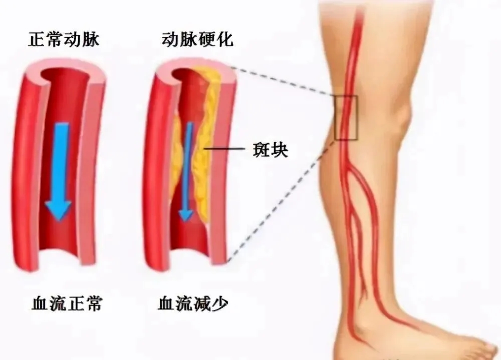 打通“健康之路”，介入手術讓你的步伐再次輕盈！