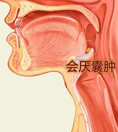 咽喉總感不適？可能是這個“小家伙”在作祟！