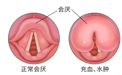 咽喉總感不適？可能是這個“小家伙”在作祟！