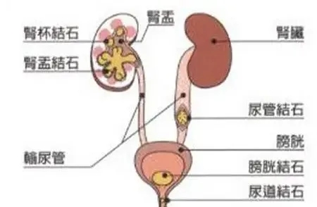 小小結石不可小覷，差點就釀成大禍!