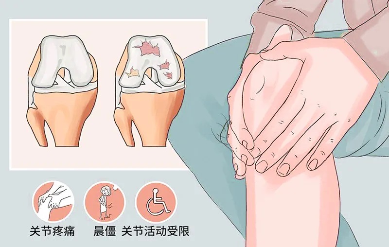 膝關節疼痛切勿強忍，且行且珍“膝”！