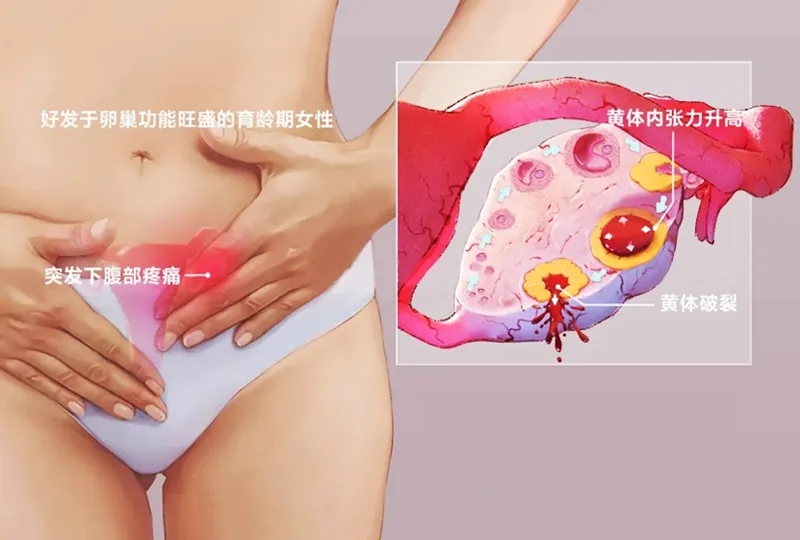 超聲“揪出”女性腹痛元兇——黃體破裂，你不可不知！