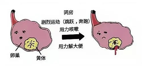 超聲“揪出”女性腹痛元兇——黃體破裂，你不可不知！