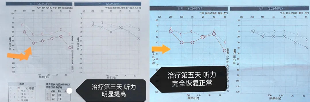 突然聽不見？原來是這個聽力殺手在作祟！